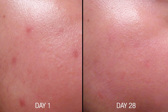 Smooth E Acne Scar Serum สมูทอี แอคเน่ สกา ซีรั่ม เจลทาแผลเป็นจากสิว